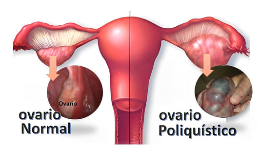 Síndrome de Ovario Poliquístico  (SOP)